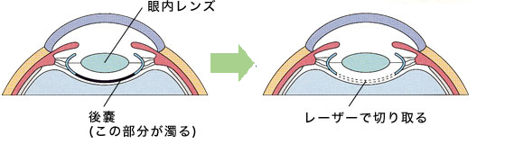 後発白内障