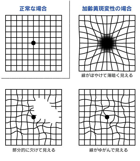 アムスラーチャートを用いた自己チェック