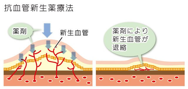 抗VEGF療法（硝子体内注射）