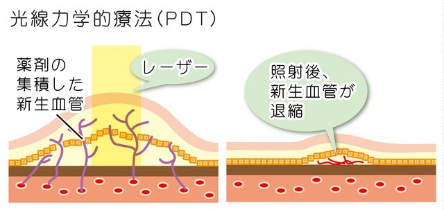 光線力学療法（PDT）