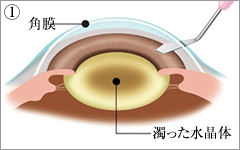 角膜（黒目）と結膜（白目）の境に小さな傷口を作ります。