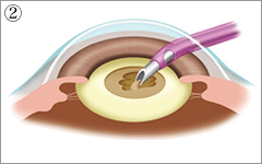 水晶体の表面に丸い穴を開け、超音波の機械で水晶体の濁りを吸引します。