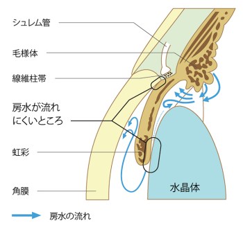 原発閉塞隅角緑内障